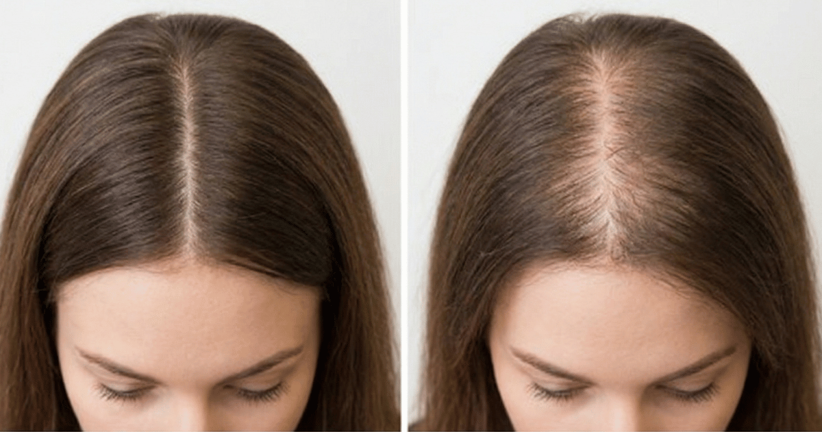 La riga dei tuoi capelli si sta allargando? Ecco cosa potrebbe stare succedendo — e cosa fare al riguardo