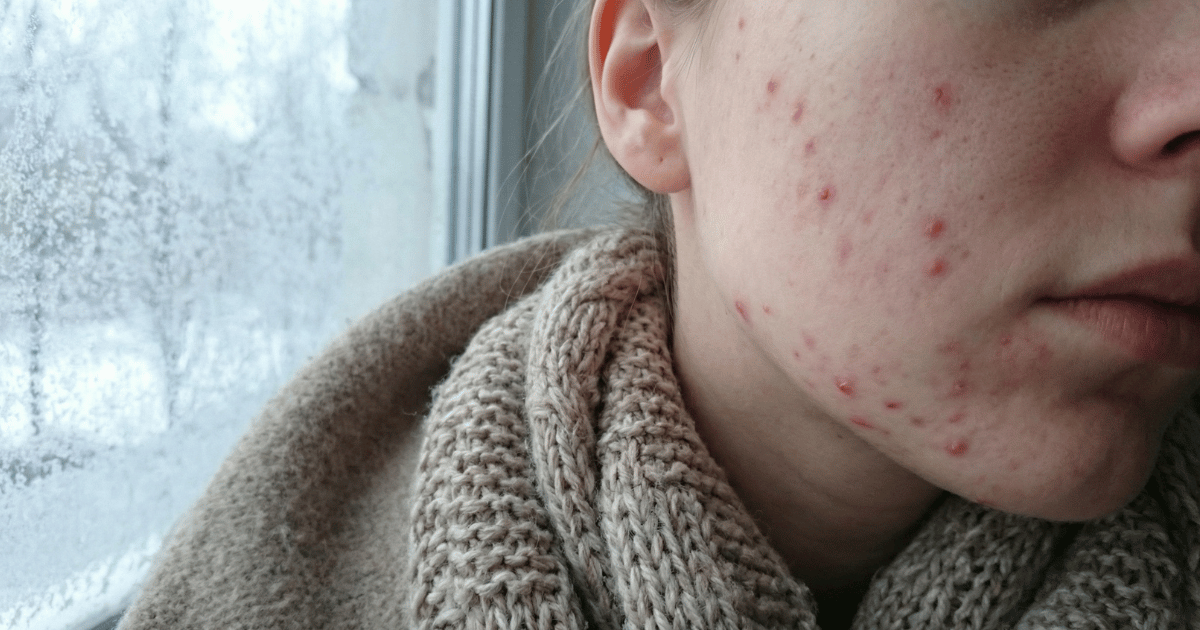 Perché i brufoli aumentano in inverno davvero? La risposta che nessuno ti spiega e i consigli di un dermatologo